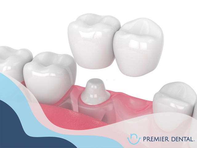 Bắc cầu răng sứ là gì