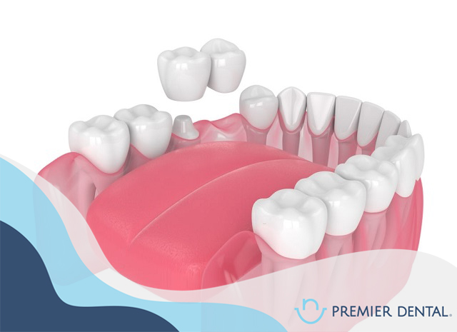 Cầu răng sứ là gì