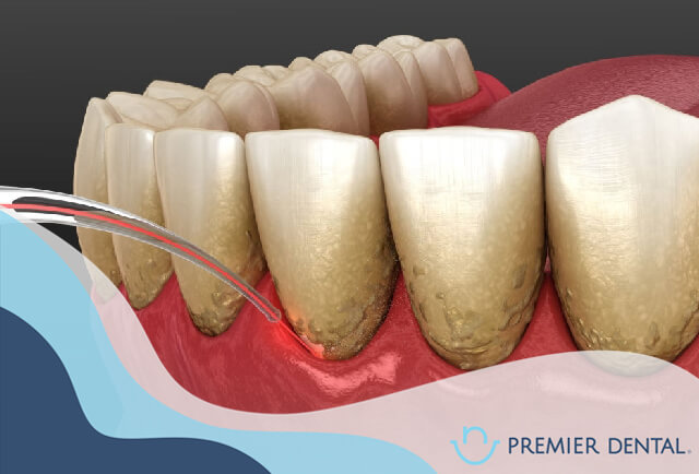 Viêm nha chu là gì