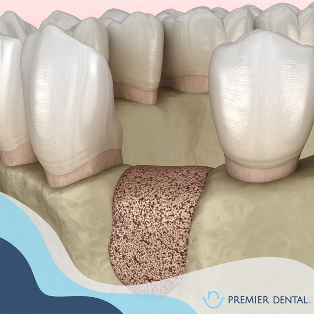 Cấy ghép xương hàm là gì