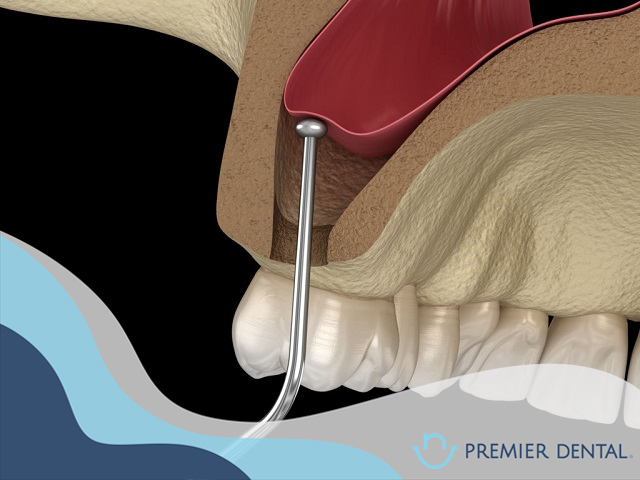 Nâng xoang hàm là gì?
