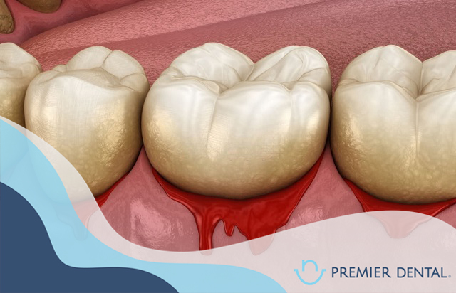 Chảy máu răng có phải bị viêm nha chu