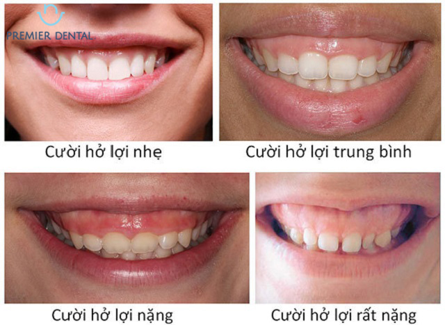 phẫu thuật nướu răng trong điều trị cười hở lợi