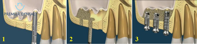 Các bước cần thiết trong quá trình nâng xoang và cấy ghép Implant