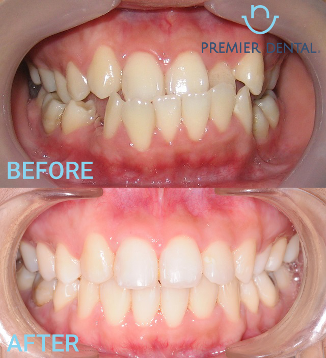 Niềng răng mắc cài sứ xong nhìn sẽ ra sao