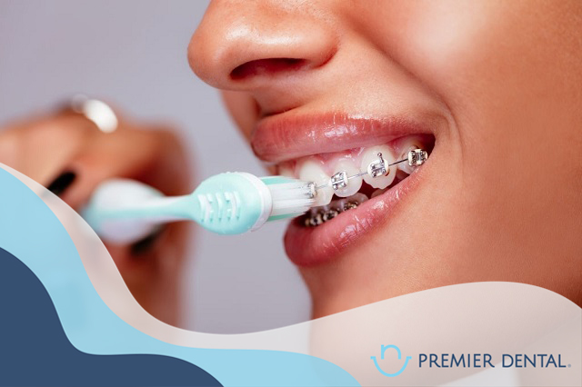 Niềng răng vệ sinh như thế nào
