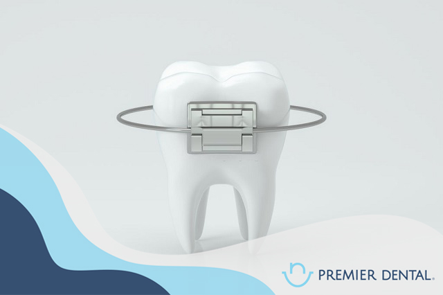 Niềng răng mắc cài kim loại có tốt không