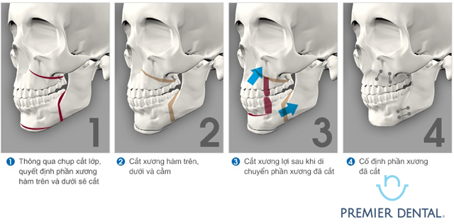 Niềng răng hỗ trợ điều trị khớp cắn