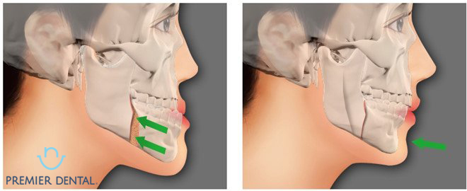 Phẫu thuật gọt hàm