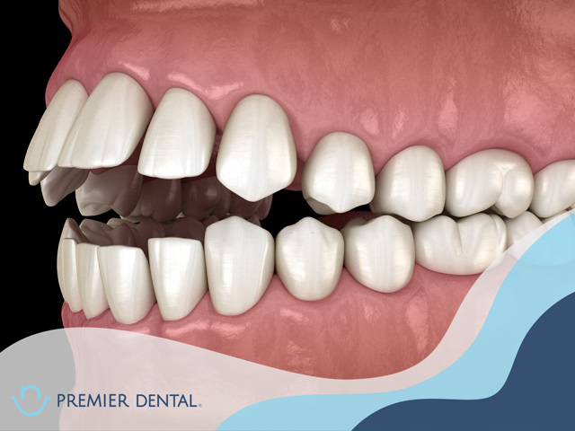 Khi nào cần niềng răng