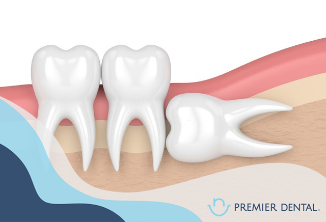 Răng khôn mọc ngang gây ảnh hưởng đến răng kế cận