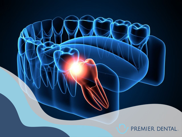 Răng khôn mọc lệch có thể gây nhiễm trụng cho vùng răng kế cận