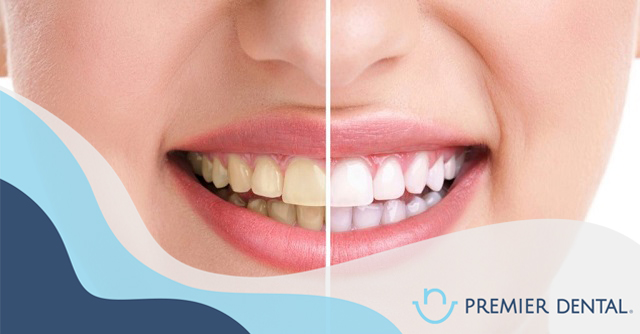 Máng tẩy trắng răng có hiệu quả không