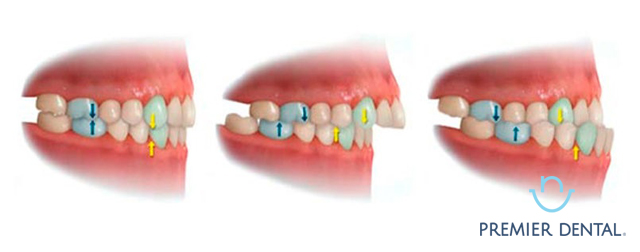 Các loại khớp cắn