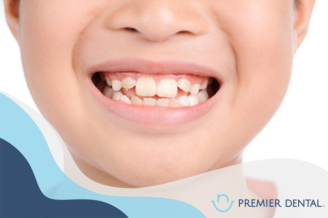 Niềng răng ở đâu uy tín