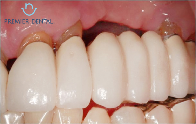 Nguy cơ khi làm cầu răng sứ