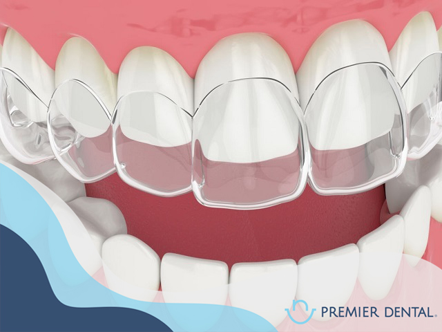 Niềng răng không mắc cài là gì