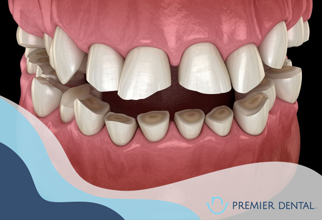 Răng mọc lệch là gì