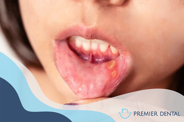 Lở miệng là gì