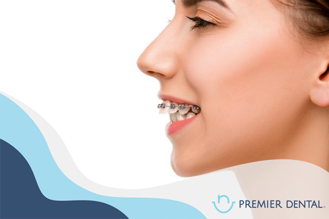 Tại sao phải niềng răng