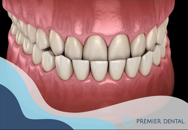 Niềng răng có tốt không