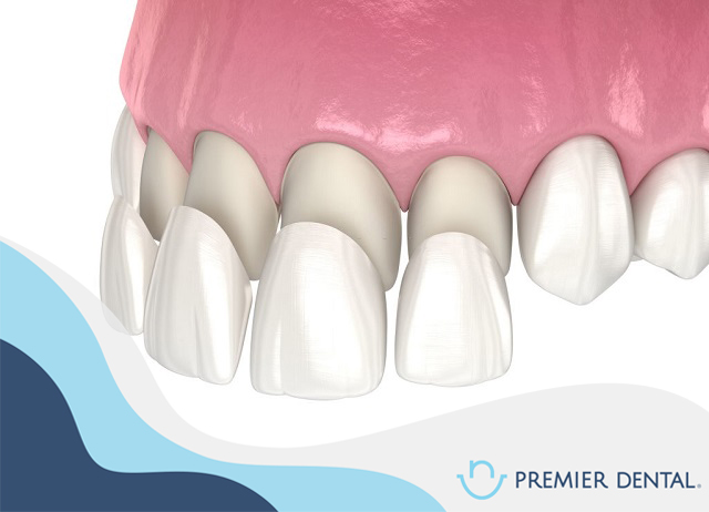 Dán veneer thẩm mỹ là gì