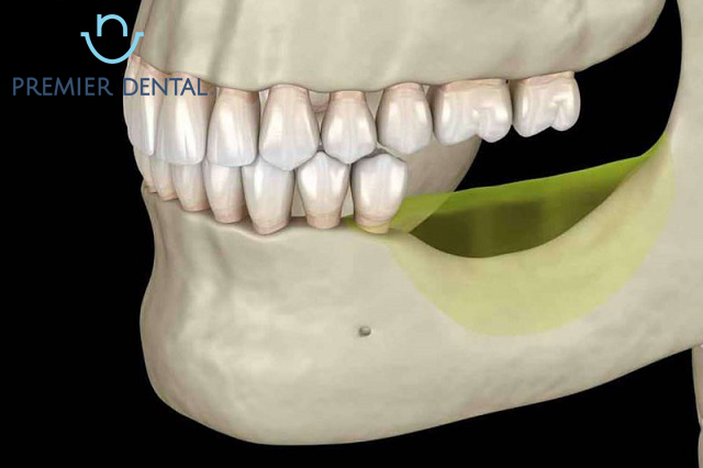 Phần xương răng bị tiêu hao cần cấy ghép xương